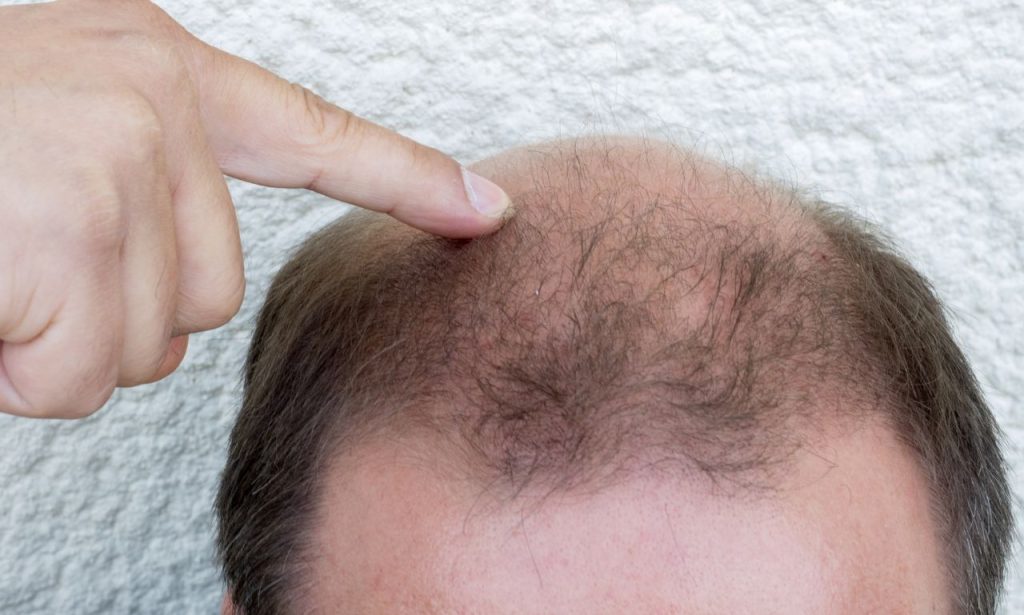 hair transplant near me (at no cost)