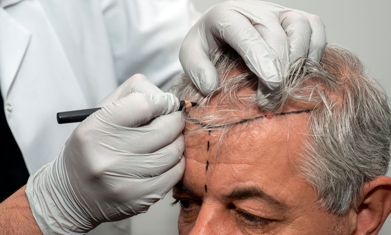 hair transplant near me (at no cost)