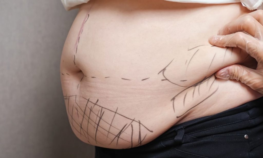 Why Does Liposuction Hurt So Bad?