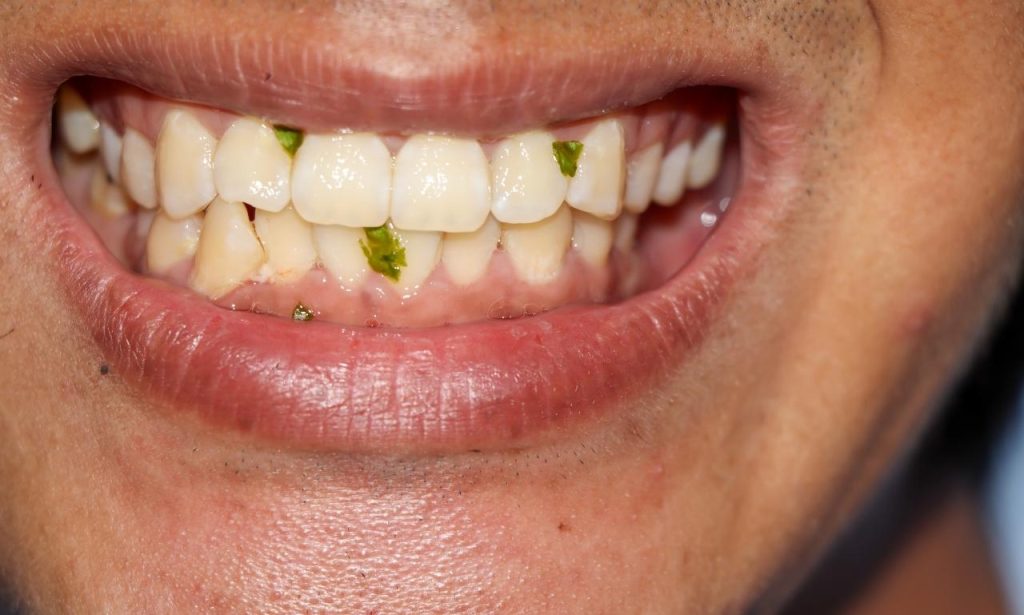 Why Do My Teeth Keep Breaking?