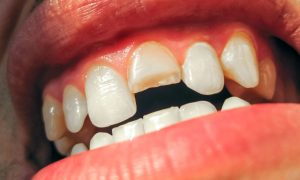 Why Do My Teeth Keep Breaking?