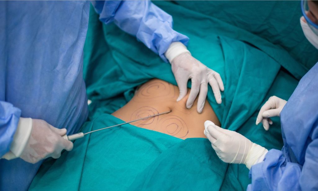 Why Does Liposuction Hurt So Bad?