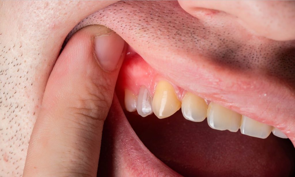 what are the 5 stages of periodontal disease