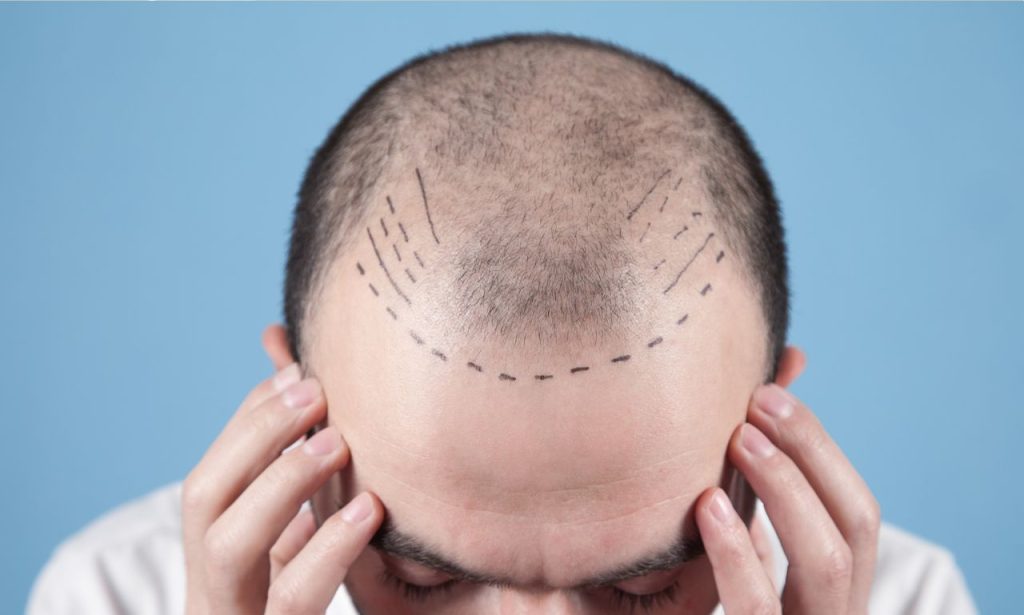 hair transplant near me (at no cost)