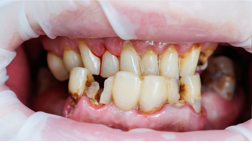 Why Do My Teeth Keep Breaking?